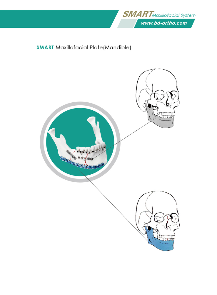 SMART Maxillofacial Plate(Mandible)
