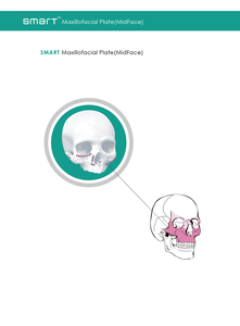 SMART Maxillofacial Plate(MidFace)
